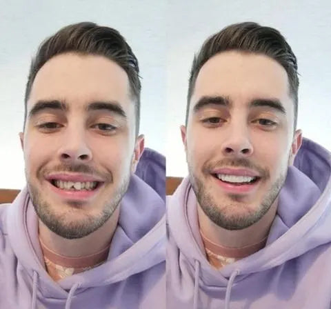 On Smile Veneers (Ober- und Unterkiefer inbegriffen)